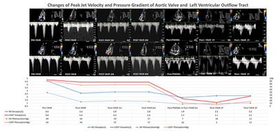 Case Report: Minimally Invasive Therapy by Transcatheter Aortic Valve Replacement and Percutaneous Intramyocardial Septal Radiofrequency Ablation for a Patient With Aortic Stenosis Combined With Hypertrophic Obstructive Cardiomyopathy: Two-Year Follow-Up Results